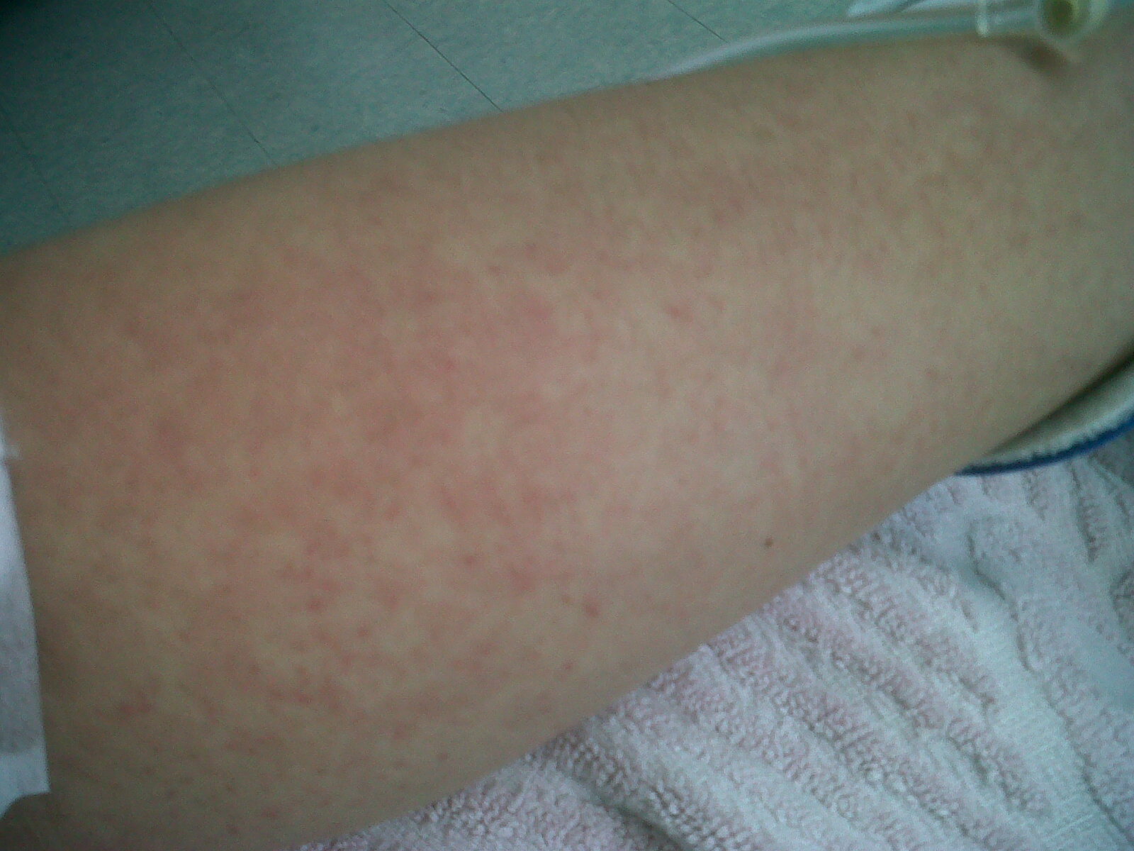 dengue recovery rash